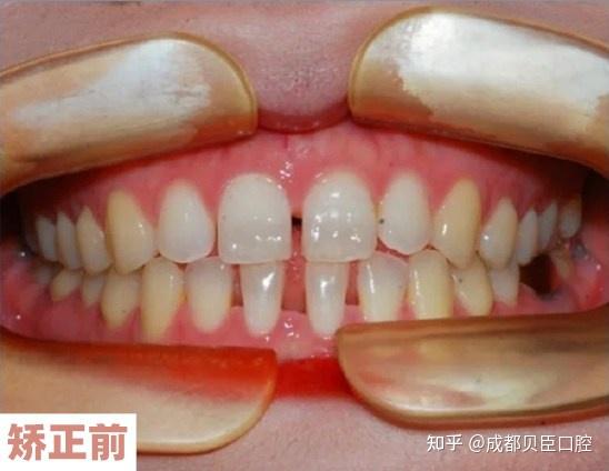 成都牙齿稀疏,牙缝大的朋友,通过牙齿矫正就能恢复正常.