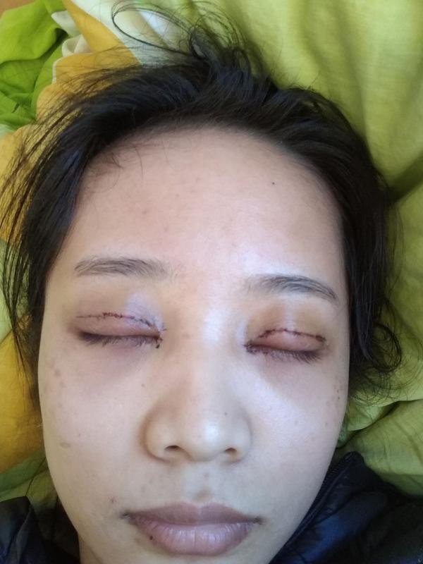 双眼皮 全切6mm&开眼角