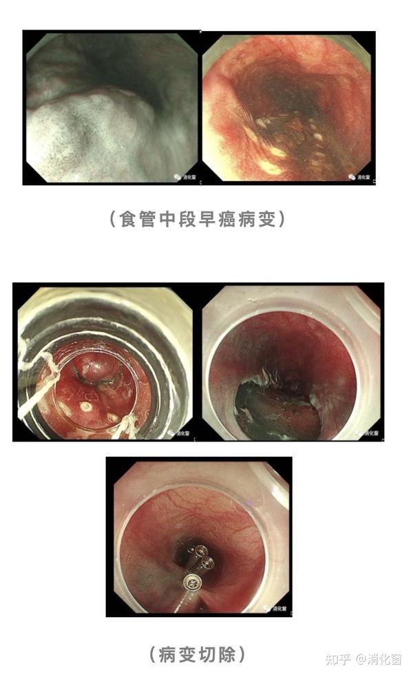 submucosal dissection,esd),是近年来出现的一项新的治疗手段,也是