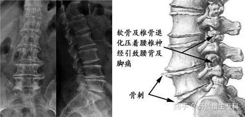 骨质增生是什么原因引起的5点常见因素根据自身对照减少