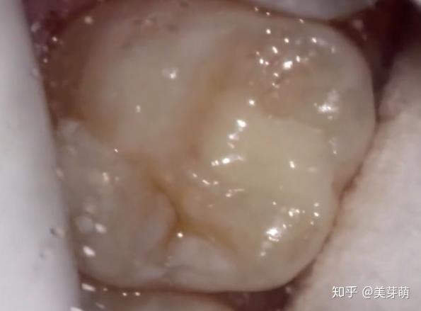 补牙医生揭露:蛀牙内部的真实情况,虫牙里真的有虫子吗?