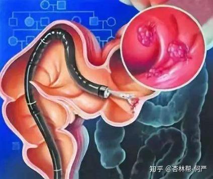 直肠癌术前术后化疗注意事项——肛肠外科专家隋金珂科普系列