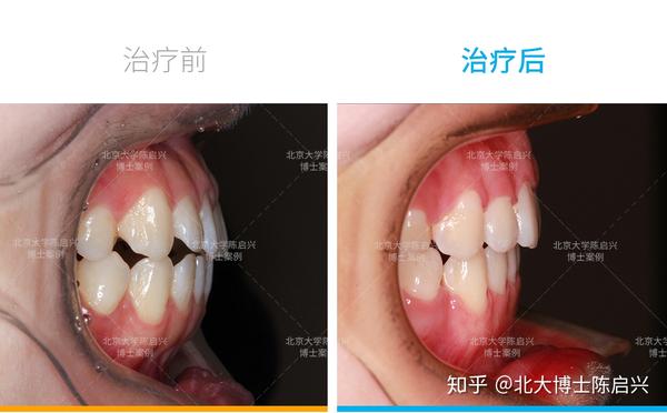 骨性嘴突前牙无法咬合拔牙矫正案例