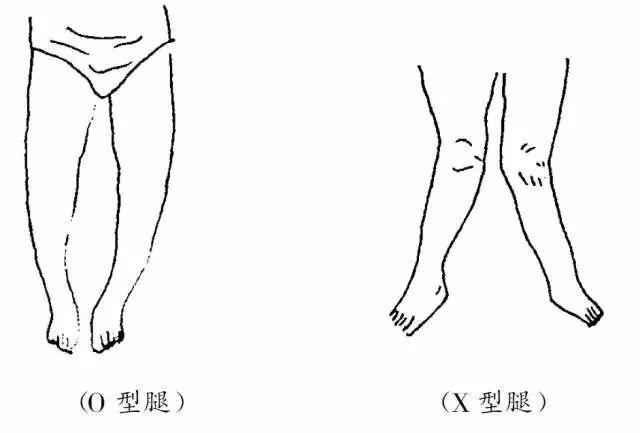 宝宝肋外翻,o型腿,x型腿是缺钙吗?