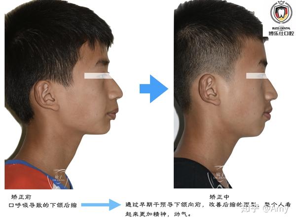 11岁的男孩因为口呼吸导致的下颌后缩,接受正畸治疗9个月后,下颌后缩