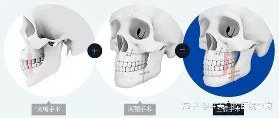 颌面手术到底能解决什么问题?广州到哪里才能做颌面手术?