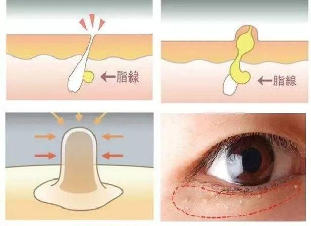 求怎么去除眼皮上的脂肪粒在眼皮上根本不敢用粉刺针挑眼皮上特爱长这