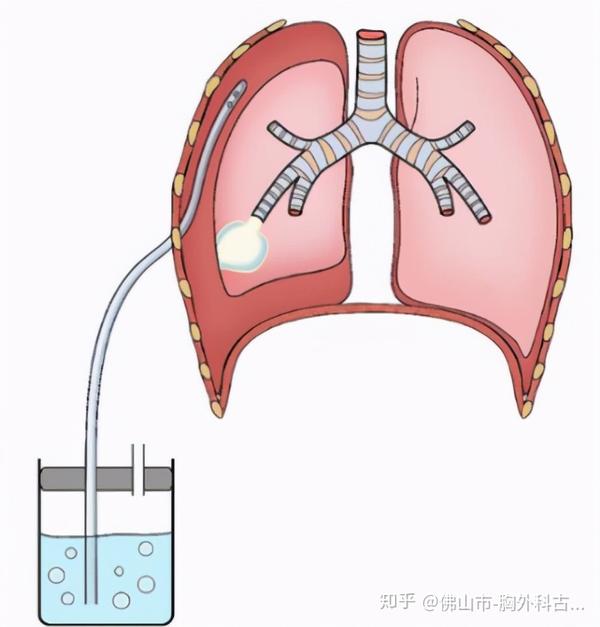肺真的会气炸吗?
