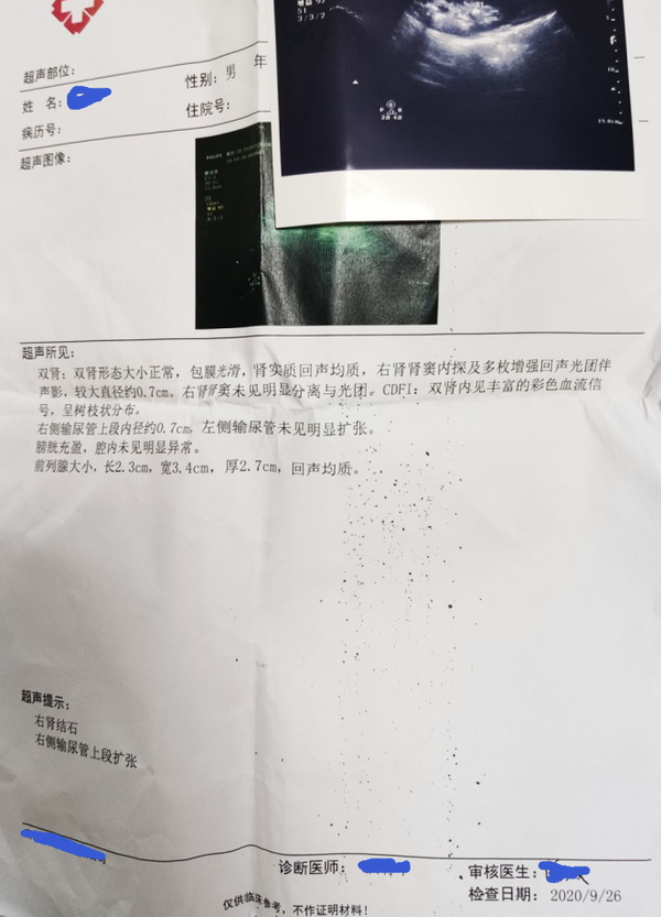 7mm肾结石一颗排出分享