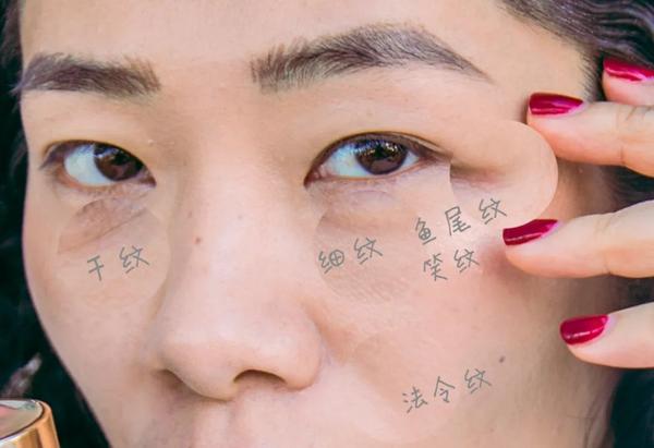 周围会有很多问题,像干纹细纹,眼头的川字纹以及眼角的鱼尾纹和笑纹