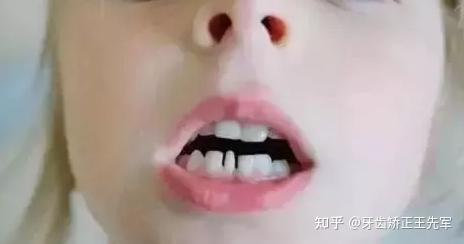 苏州正畸牙齿矫正为什么会有黑三角如何避免