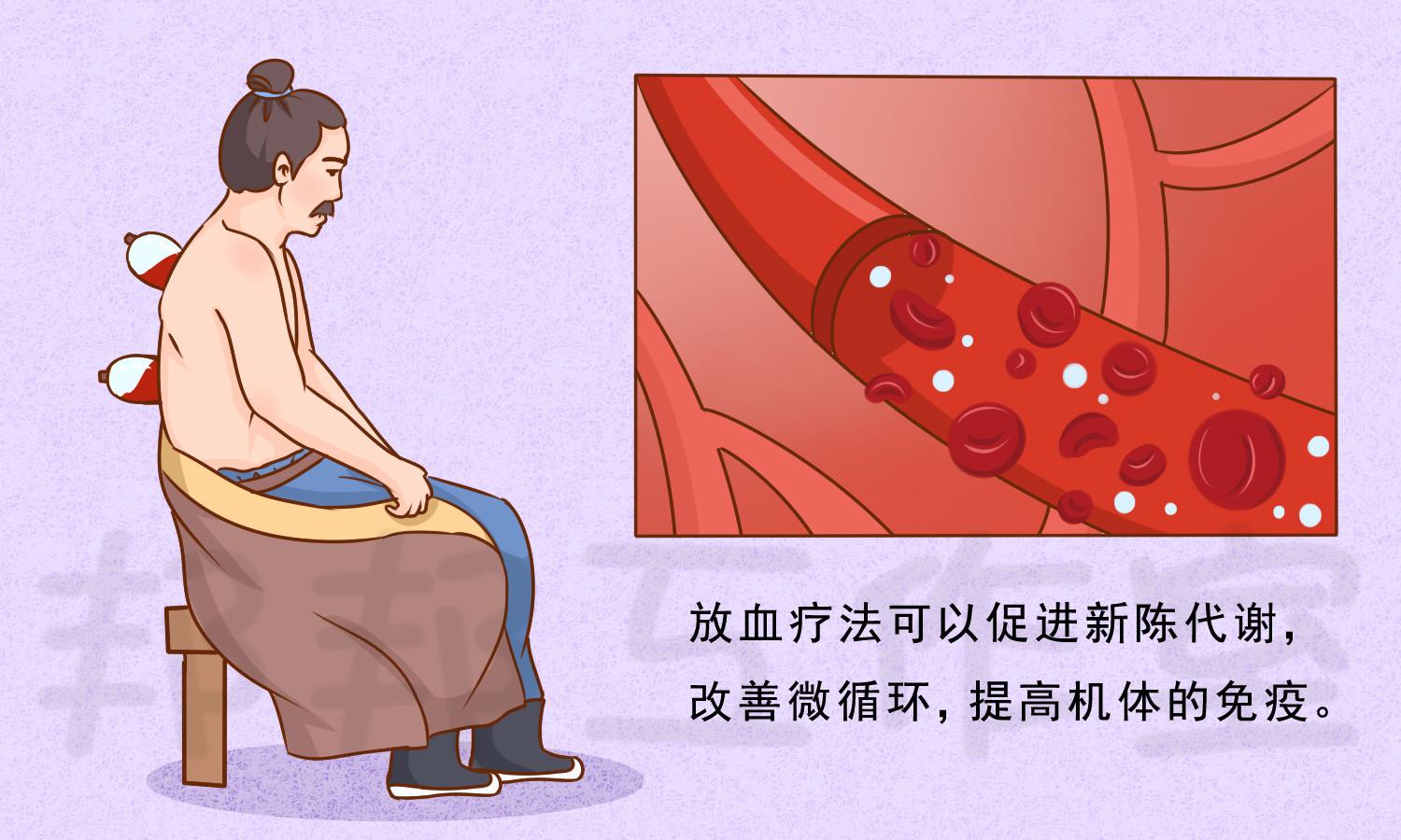 如何看待银屑病放血疗法