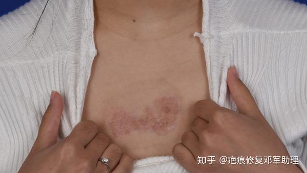 胸口疤痕疙瘩切除记录