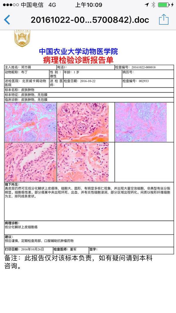 低分化鳞状细胞癌是什么病?