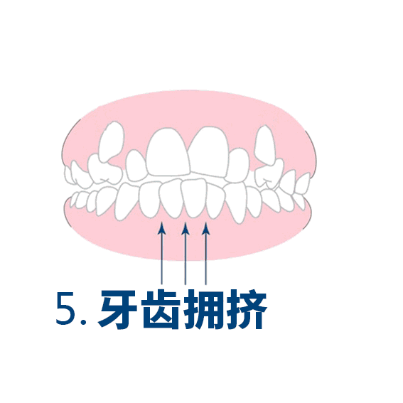 牙齿拥挤 — 导致"没下巴"