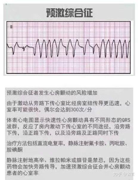 医学生笔记(图解|最全面的心电图波形解析)(个人笔记