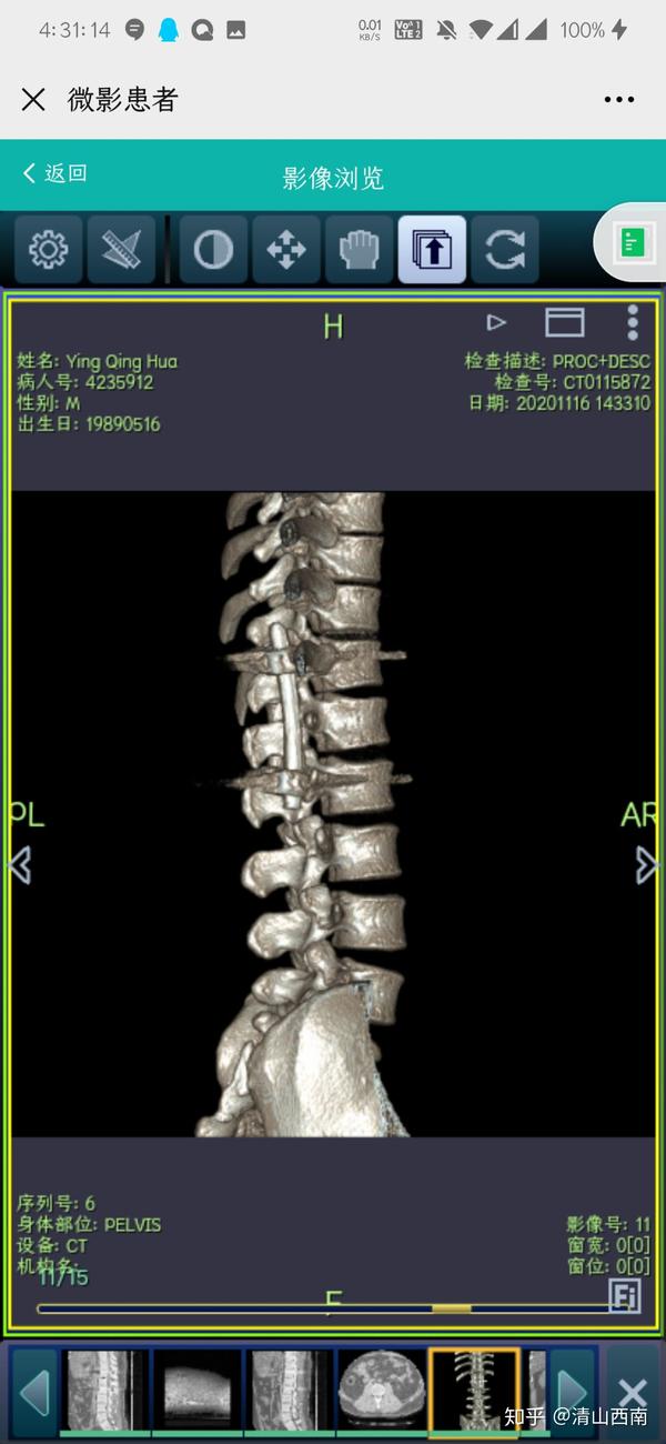 腰椎l1压缩性骨折术后ct图
