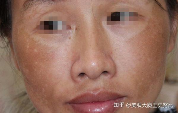 为什么你的皮肤会变成铅汞激素脸怎么才能治疗铅汞中毒斑