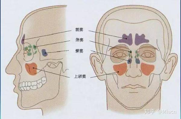 所谓的化脓性鼻炎就鼻窦里面发炎,产生脓液了.