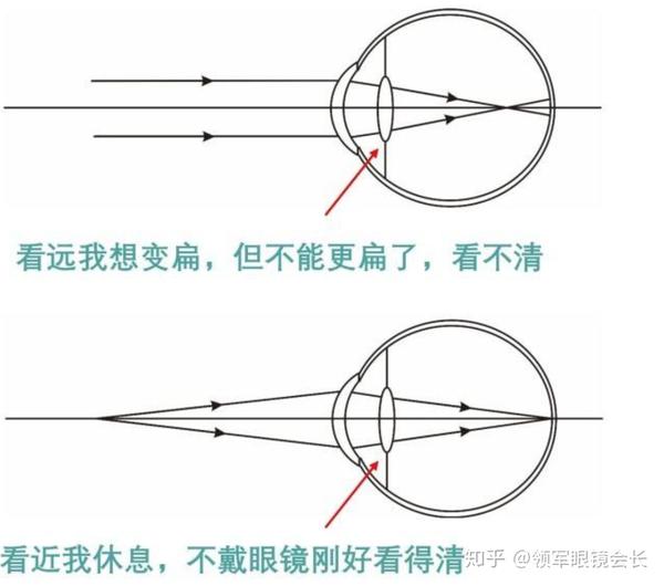 近视眼老了之后是近视眼还是老花眼还是正常眼