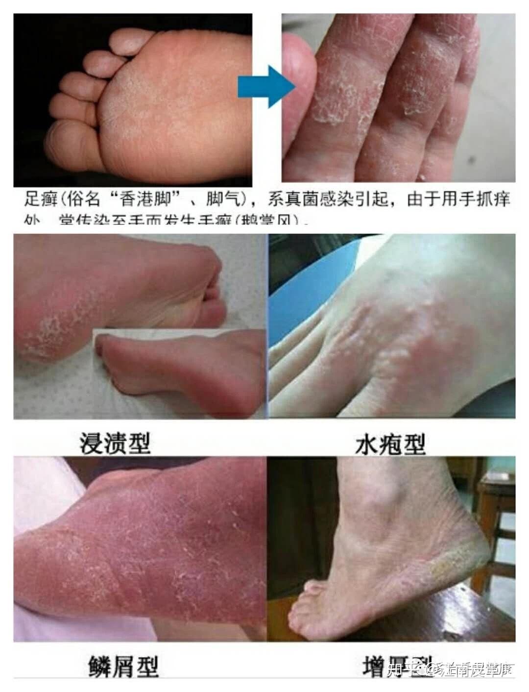 各种脚部问题皮肤病案例对照表