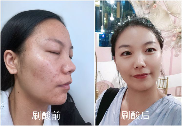 皮肤在什么情况下需要刷酸?如何选择酸的种类?