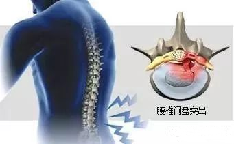 副教授 下腰痛:下腰痛也是腰椎间盘突出常见的症状之一,当后腰椎间盘