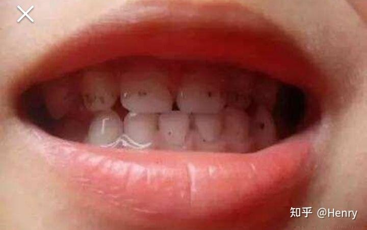 孩子牙上有小黑点是怎么引起的