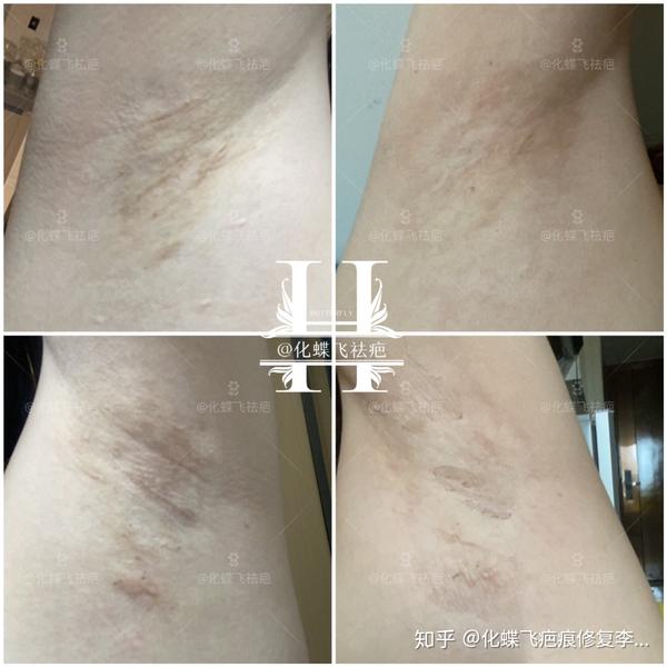 腋下手术疤痕,中药修复效果这么好,竟然还想打激光,我
