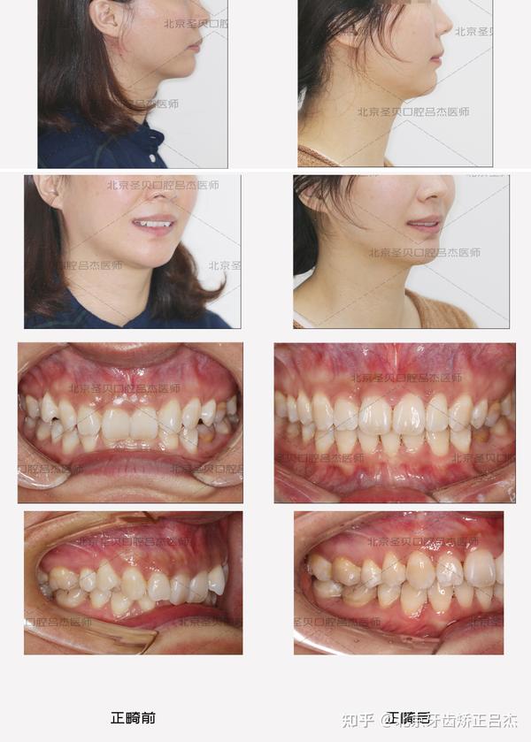 严重的深覆合在咬合时下颌牙齿会咬到上颌牙龈,产生疼痛,红肿,使上牙