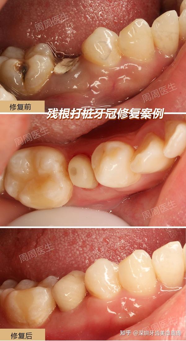 深圳根管治疗牙齿蛀得只剩下一个残根还有必要保留吗可以保留的话怎么