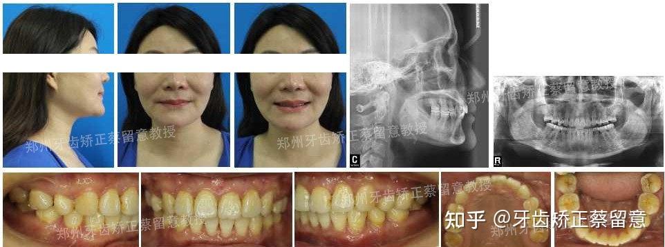 郑州牙齿矫正个性化舌侧矫正骨性疑难正畸病例的优选解决方式