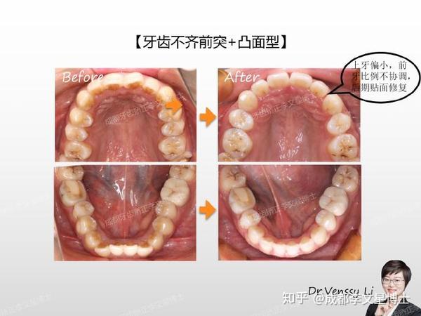 成都牙齿矫正李文星博士:『牙齿拥挤不齐 凸面型』隐形矫正案例