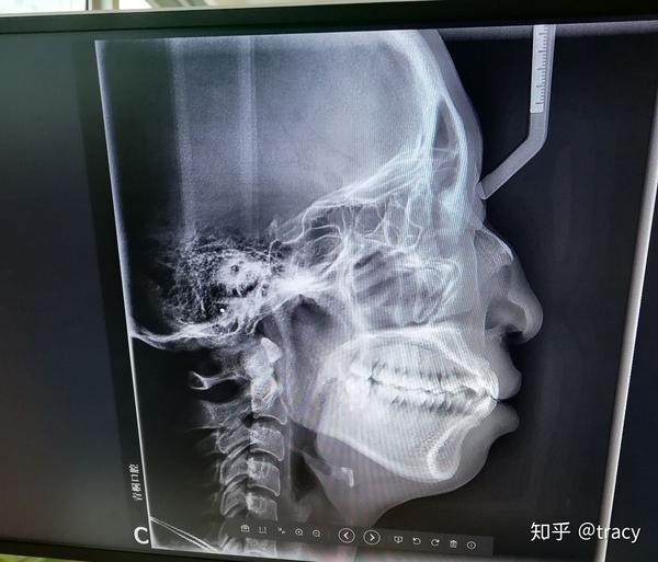 什么原因让你最终下定决心做牙齿矫正?
