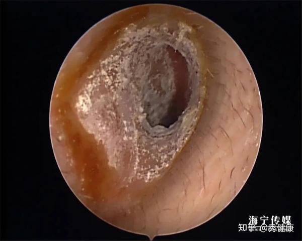 双侧耳道表面布满密密麻麻的白色绒毛物体,被诊断为"外耳道真菌病"