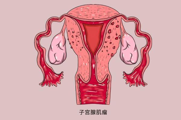 子宫肌瘤的症状及危害