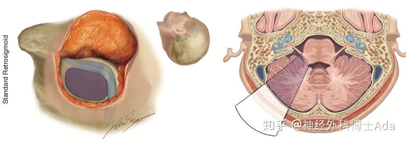 听神经瘤三大手术要点图解经迷路后入路乙状窦后入路颞下入路