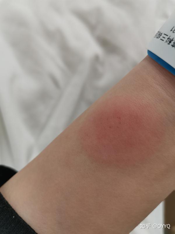 医生告知痰涂片阴性,没有找到菌,传染性比较小,但是大概率就是个结核