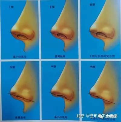 鼻翼-鼻小柱缺陷分类(图片引用自《达拉斯隆鼻术:大师的杰作》)