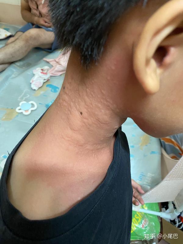 我年轻的时候也有皮肤过敏病,天气闷热过敏,手有灰尘抓痒痒也过敏