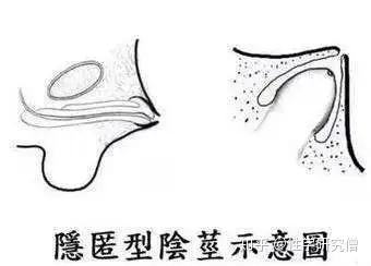 1,隐匿阴茎(concealed penis) 隐匿阴茎是由于阴 茎部肉膜发育异常