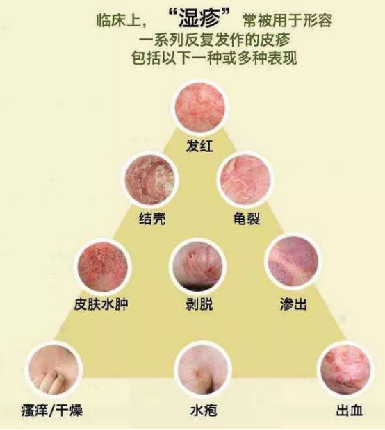 什么叫湿疹 知乎