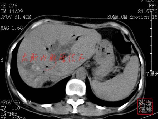 肝内胆管结石典型病例:左外叶右后叶肝内胆管结石,oddis括约肌松驰