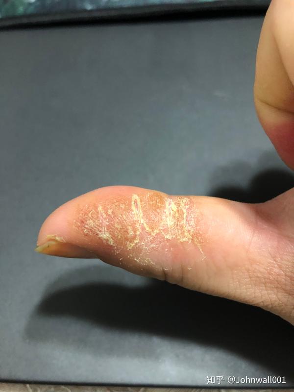 手指皮肤变硬干裂发痒医生说是湿疹怎么办