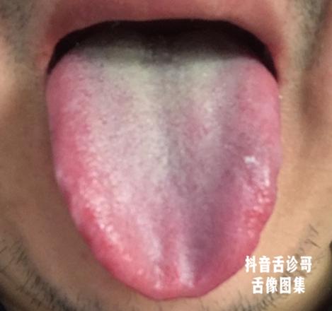 抖音舌诊哥:舌诊知健康,教你学会看舌象系列三十三