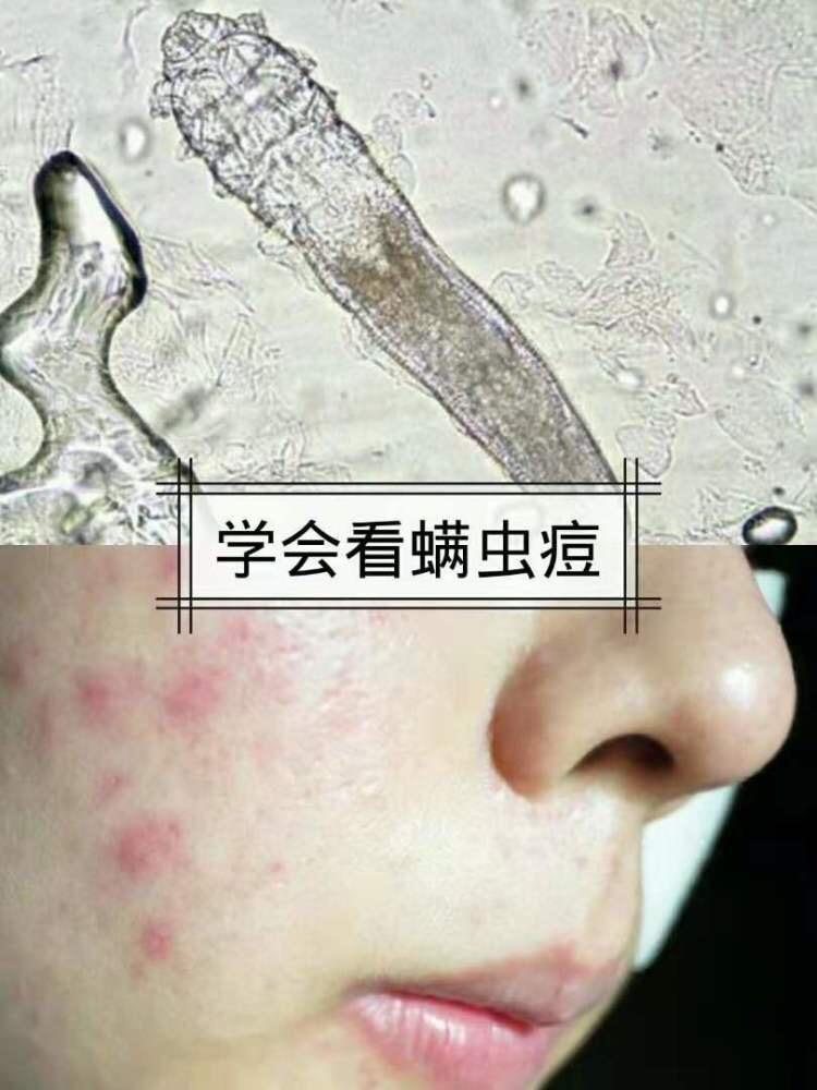 说明螨虫也正在侵袭你脸部:油光满面的,毛孔粗大;鼻子上的黑头白头