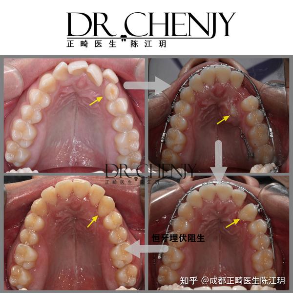 成都整牙成都矫正牙齿案例分享正畸过程中如何实现埋伏牙的助萌