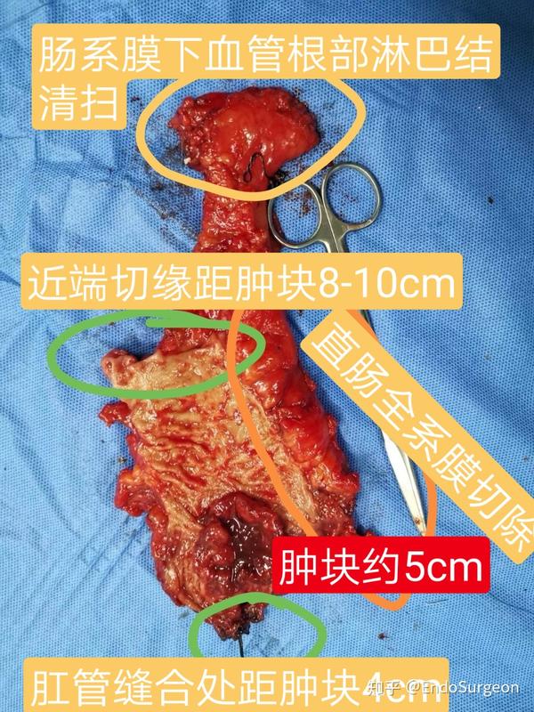 前者因为需要永久人工肛门,生活质量极大影响.