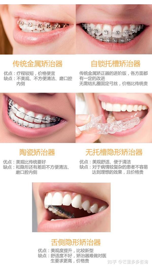 【上海整牙】上海牙齿矫正的正畸医院医生求推荐?牙套