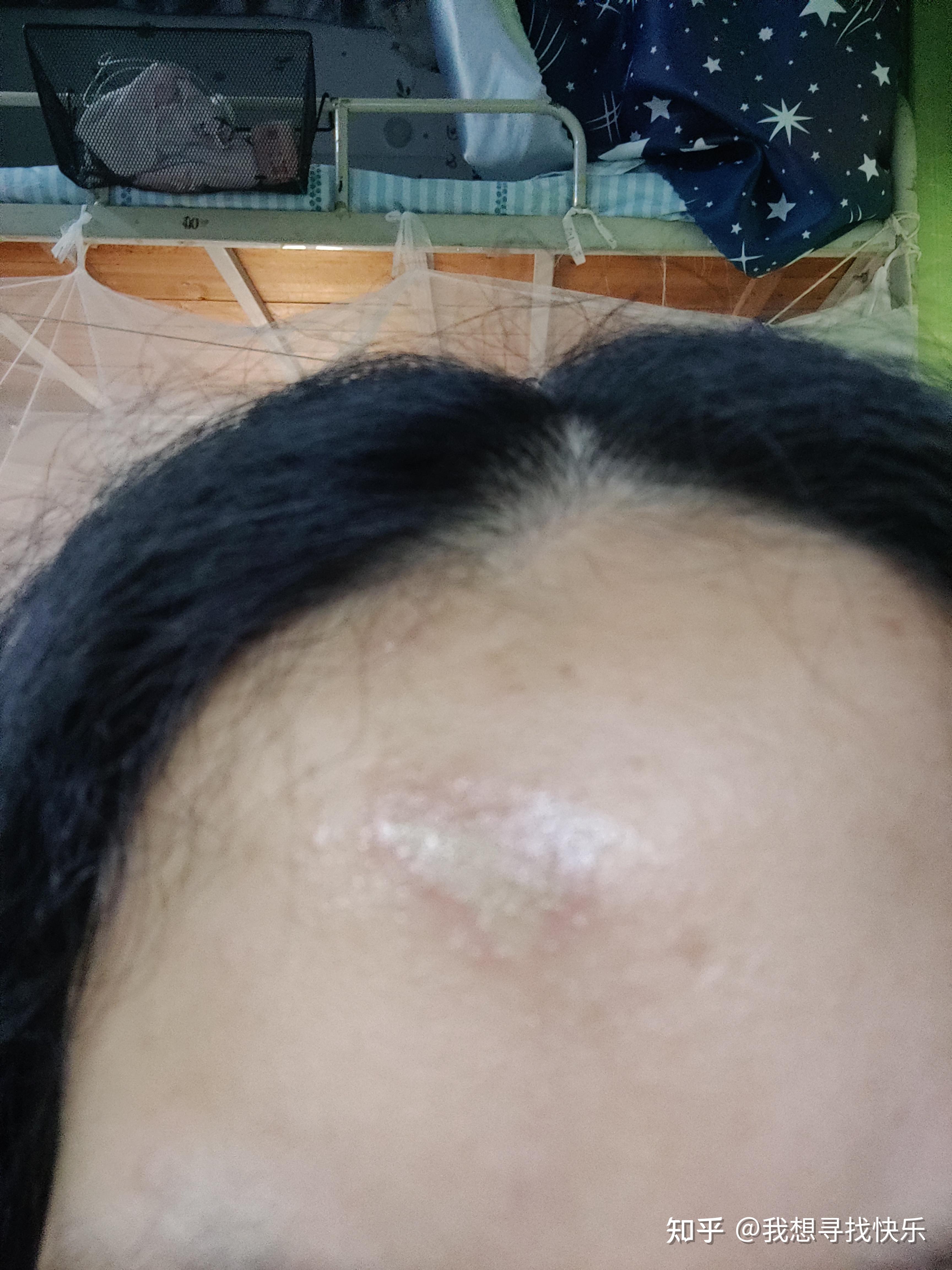 记录一次隐翅虫皮炎